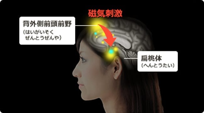 受験うつの症状を回復 磁気刺激治療 Tms うつ病の予防や治療なら うつ病ナビ