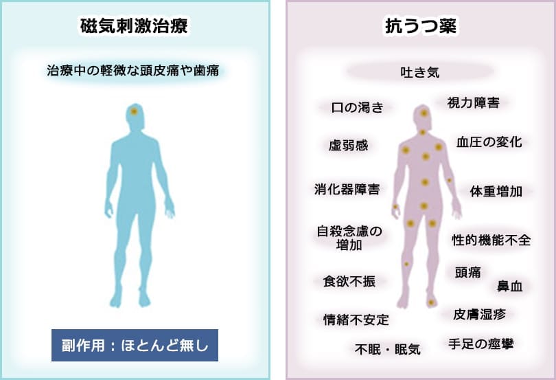 Tms治療 うつ磁気刺激治療 とは うつ病の予防や治療なら うつ病ナビ